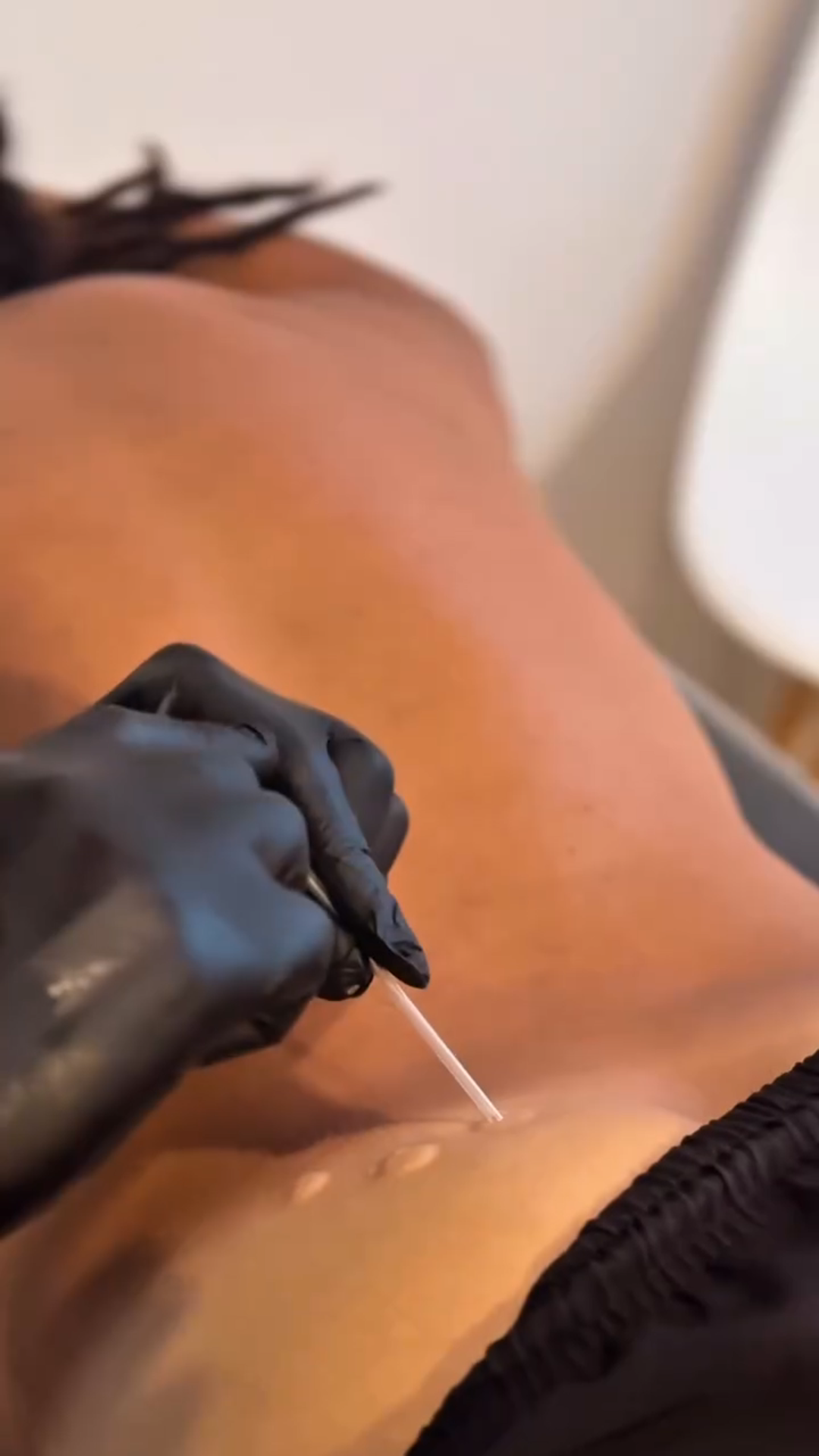 Dry Needling em Angra dos Reis
